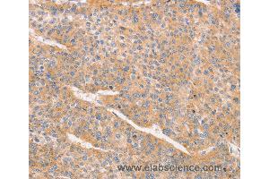 Immunohistochemistry of Human liver cancer using CD2AP Polyclonal Antibody at dilution of 1:70 (CD2AP anticorps)
