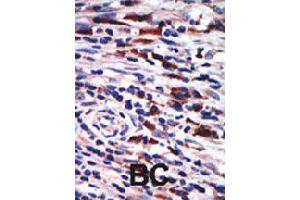 Formalin-fixed and paraffin-embedded human cancer tissue reacted with PRKCH polyclonal antibody  , which was peroxidase-conjugated to the secondary antibody, followed by AEC staining . (PKC eta anticorps  (N-Term))