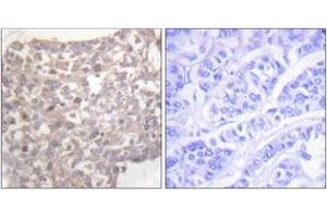 Immunohistochemistry analysis of paraffin-embedded human breast carcinoma tissue, using Tubulin gamma Antibody. (TUBG1 anticorps  (AA 386-435))