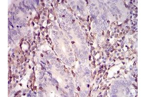 Immunohistochemical analysis of paraffin-embedded colon cancer tissues using WAS mouse mAb with DAB staining.