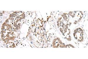 Immunohistochemistry of paraffin-embedded Human esophagus cancer tissue using BAG2 Polyclonal Antibody at dilution of 1:40(x200) (BAG2 anticorps)