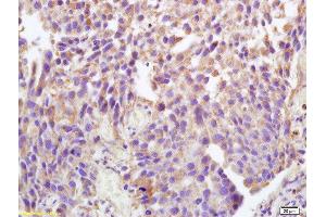Formalin-fixed and paraffin embedded human bladder carcinoma labeled with Anti-Phospho-ATP1A1(Tyr10)Polyclonal Antibody, Unconjugated  at 1:200 followed by conjugation to the secondary antibody and DAB staining.