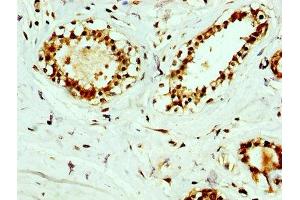 IHC image of ABIN7167302 diluted at 1:400 and staining in paraffin-embedded human breast cancer performed on a Leica BondTM system. (RAB35 anticorps  (AA 1-201))
