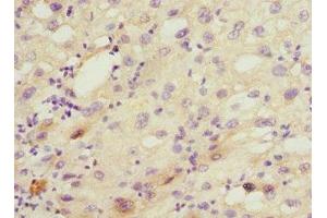 Immunohistochemistry of paraffin-embedded human liver cancer using ABIN7149242 at dilution of 1:100