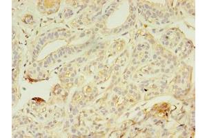 Immunohistochemistry of paraffin-embedded human breast cancer using ABIN7176718 at dilution of 1:100 (AZGP1 anticorps  (AA 61-210))