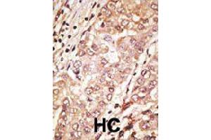 Formalin-fixed and paraffin-embedded human hepatocellular carcinoma tissue reacted with TDGF1 polyclonal antibody  , which was peroxidase-conjugated to the secondary antibody, followed by AEC staining. (TDGF1 anticorps  (N-Term))