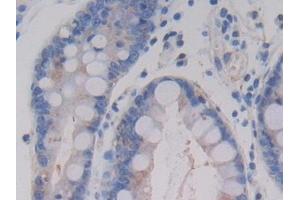 Detection of AMH in Human Stomach cancer Tissue using Monoclonal Antibody to Anti-Mullerian Hormone (AMH) (AMH anticorps)