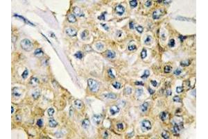 Immunohistochemistry analyzes of DAPP1 antibody in paraffin-embedded human breast carcinoma tissue. (DAPP1 anticorps)