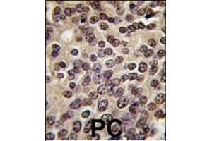 Formalin-fixed and paraffin-embedded human prostata carcinoma tissue reacted with PKN beta antibody (C-term), which was peroxidase-conjugated to the secondary antibody, followed by DAB staining. (PKN beta anticorps  (C-Term))