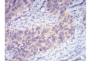 Immunohistochemical analysis of paraffin-embedded cervical cancer tissues using DDX3X mouse mAb with DAB staining.