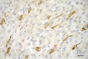 Immunohistochemistry was performed on paraffin-embedded human melanoma using phospho-CDK2 (Thr14) antibody (ABIN7798210), 1:200).