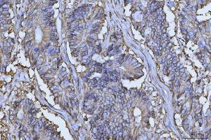 IHC analysis of CD147/Emmprin using anti-CD147/Emmprin antibody (ABIN7599999). (CD147 anticorps  (AA 138-323))