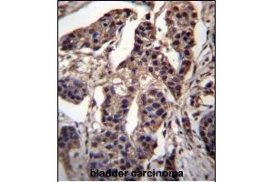 CABIN486182 and ABIN1535563 Antibody (N-term) (ABIN657088 and ABIN2837891) immunohistochemistry analysis in formalin fixed and paraffin embedded human bladder carcinoma followed by peroxidase conjugation of the secondary antibody and DAB staining. (C7ORF25 anticorps  (N-Term))