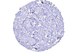 SDH deficient paraganglioma lacking granular SDHB staining in all tumor cells while stroma cells are positive.
