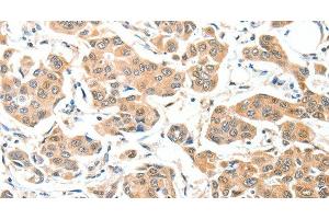 Immunohistochemistry of paraffin-embedded Human breast cancer tissue using ADCK1 Polyclonal Antibody at dilution 1:40 (ADCK1 anticorps)