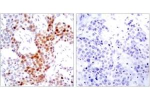 Immunohistochemistry analysis of paraffin-embedded human breast carcinoma, using ATF2 (Phospho-Thr69 or 51) Antibody. (ATF2 anticorps  (pSer69))
