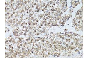 Immunohistochemistry of paraffin-embedded human breast cancer using ESR1 antibody. (Estrogen Receptor alpha anticorps  (AA 1-190))