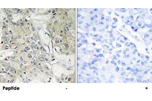 Immunohistochemistry analysis of paraffin-embedded human breast carcinoma tissue, using ANO9 polyclonal antibody . (ANO9 anticorps)