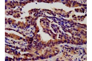 IHC image of ABIN7152837 diluted at 1:450 and staining in paraffin-embedded human lung cancer performed on a Leica BondTM system.