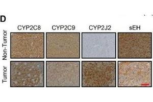 Elevated CYP2J2 expression and epoxyeicosatrienoic acid (EET) metabolism associated with homocysteine (Hcy) level in hepatocellular carcinoma (HCC)A, B.