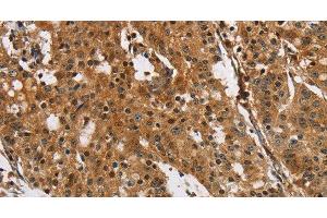Immunohistochemistry of paraffin-embedded Human gasrtic cancer tissue using PTK6 Polyclonal Antibody at dilution 1:40