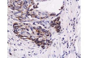Formalin-fixed and paraffin embedded human esophageal carcinoma labeled with Anti-WIG-1/PAG608 Polyclonal Antibody, Unconjugated  at 1:200, followed by conjugation to the secondary antibody and DAB staining