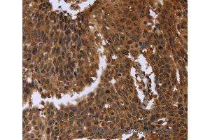 Immunohistochemistry of Human cervical cancer using FGFRL1 Polyclonal Antibody at dilution of 1:40 (FGFRL1 anticorps)