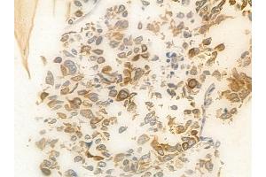 ABIN6265557 and ABIN6278407 at 1/100 staining human lung squamous cell carcinoma by IHC-P. (THOC1 anticorps  (C-Term))
