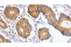 Immunohistochemistry of paraffin-embedded Human colon cancer tissue using BLNK Polyclonal Antibody at dilution 1:50 (B-Cell Linker anticorps)