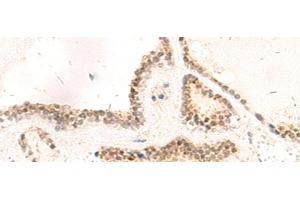 Immunohistochemistry of paraffin-embedded Human thyroid cancer tissue using RPL13A Polyclonal Antibody at dilution of 1:95(x200)