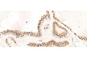 Immunohistochemistry of paraffin-embedded Human thyroid cancer tissue using RPL13A Polyclonal Antibody at dilution of 1:95(x200) (RPL13A anticorps)