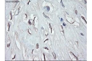 Immunohistochemical staining of paraffin-embedded Carcinoma of pancreas using anti-GATA4 (ABIN2452678) mouse monoclonal antibody. (GATA4 anticorps  (AA 296-442))