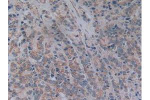IHC-P analysis of Human Prostate Gland Cancer Tissue, with DAB staining. (NT5C3 anticorps  (AA 52-336))