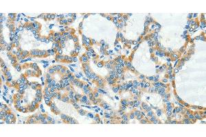 Immunohistochemistry of paraffin-embedded Human thyroid cancer tissue using L1CAM Polyclonal Antibody at dilution 1:40