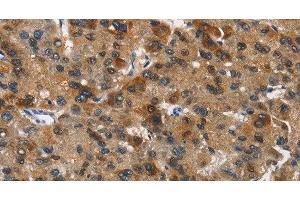 Immunohistochemistry of paraffin-embedded Human liver cancer tissue using DCC Polyclonal Antibody at dilution 1:70