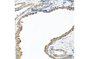 Immunohistochemistry of paraffin-embedded human prostate using NYX antibody at dilution of 1:100 (40x lens). (Nyctalopin anticorps)
