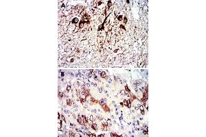 Immunohistochemical analysis of paraffin-embedded human medulla oblongata tissue (A) and liver cancer tissue (B) using TUBA8 monoclonal antobody, clone 2D6  with DAB staining. (TUBA8 anticorps)