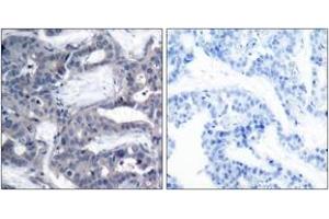 Immunohistochemistry analysis of paraffin-embedded human breast carcinoma, using MEK2 (Phospho-Thr394) Antibody.