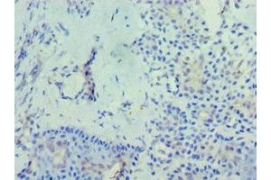 Immunohistochemistry of paraffin-embedded human breast cancer using ABIN7163439 at dilution of 1:100 (PHYH anticorps  (AA 1-338))