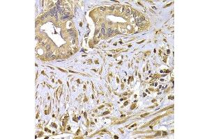 Immunohistochemistry of paraffin-embedded human liver cancer using FSCN1 antibody at dilution of 1:100 (x400 lens). (Fascin anticorps)