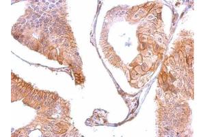 IHC-P Image EGFR antibody [C2C3], C-term detects EGFR protein at membrane on human gastric cancer by immunohistochemical analysis. (EGFR anticorps  (C-Term))
