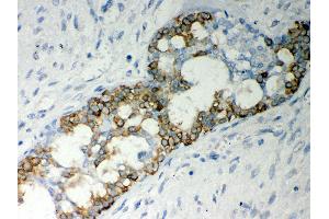 Anti- Caspase-7 Picoband antibody,IHC(P) IHC(P): Human Mammary Cancer Tissue (Caspase 7 anticorps  (AA 117-198))
