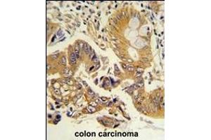 Formalin-fixed and paraffin-embedded human colon carcinoma reacted with CLNS1A Antibody (Center), which was peroxidase-conjugated to the secondary antibody, followed by DAB staining. (CLNS1A anticorps  (AA 148-176))