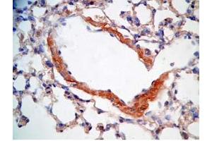 Mouse lung cancer tissue stained by Rabbit Anti-CRAMP (Mouse) Antibody