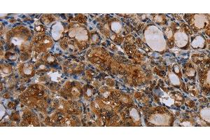 Immunohistochemistry of paraffin-embedded Human thyroid cancer using CD116 Polyclonal Antibody at dilution of 1:35 (CSF2RA anticorps)