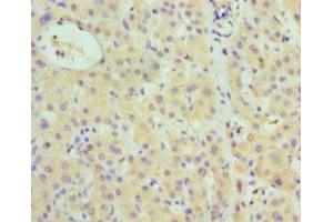 Immunohistochemistry of paraffin-embedded human liver cancer using ABIN7148380 at dilution of 1:100 (Complement Factor B anticorps  (AA 26-751))