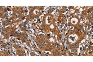Immunohistochemistry of paraffin-embedded Human gastric cancer tissue using CEACAM3 Polyclonal Antibody at dilution 1:30 (CEACAM3 anticorps)