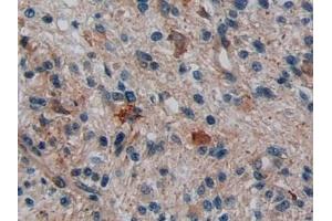 Detection of DISC1 in Human Glioma Tissue using Polyclonal Antibody to Disrupted In Schizophrenia 1 (DISC1) (DISC1 anticorps  (AA 102-261))