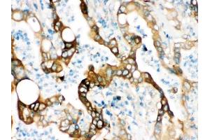 IHC analysis of FASN using anti-FASN antibody (ABIN3044520). (Fatty Acid Synthase anticorps  (AA 1-226))