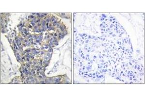 Immunohistochemistry analysis of paraffin-embedded human breast carcinoma tissue, using MUNC-18a (Ab-313) Antibody. (STXBP1 anticorps  (AA 279-328))